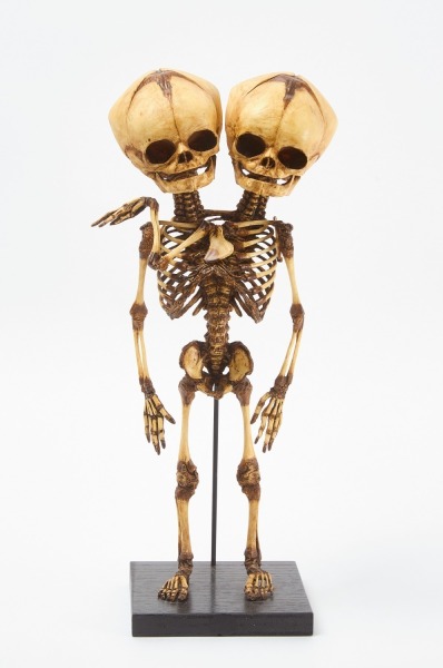 Conjoined Twin Mounted Fetal Skeleton Replica